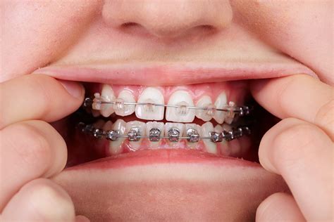 bracket metal mini orthodontic|metal braces with clear bands.